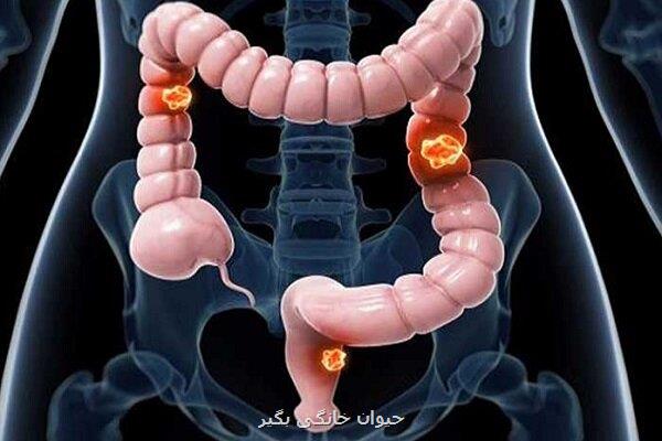 ایمونوتراپی در درمان سرطان پیشرفته کولورکتال بدون جراحی موثر است