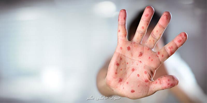 زنگ خطر سرخک در شمال کشور