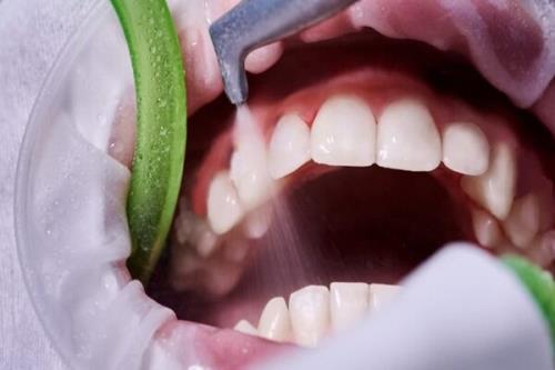 ضرورت سلامت دهان و جلوگیری از بیماری های لثه ای