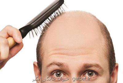 50 درصد ایرانیان مشكل ریزش موی سر دارند